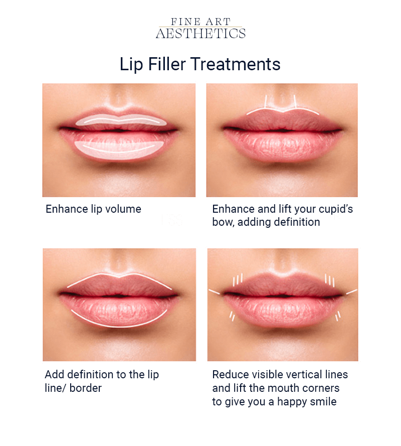 Lip Filler Treatments - Fine Art Aesthetics